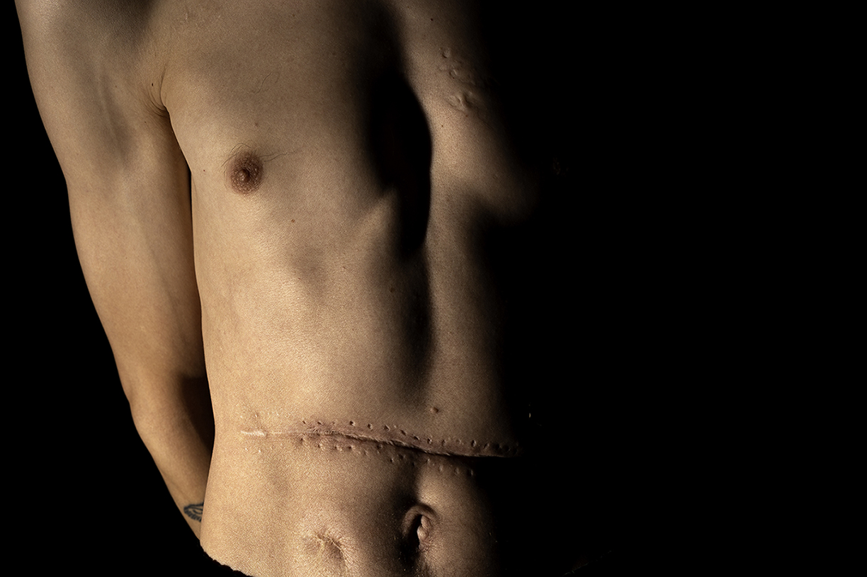Photograph of a male torso with a horizontal scar across the stomach.