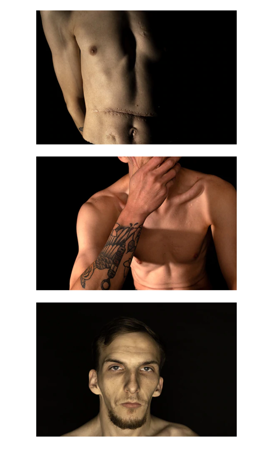 three stacked pictures of Austin Irby – top shows abdomen with scar, middle shows one arm curled to mouth, bottom shows face with no smile 